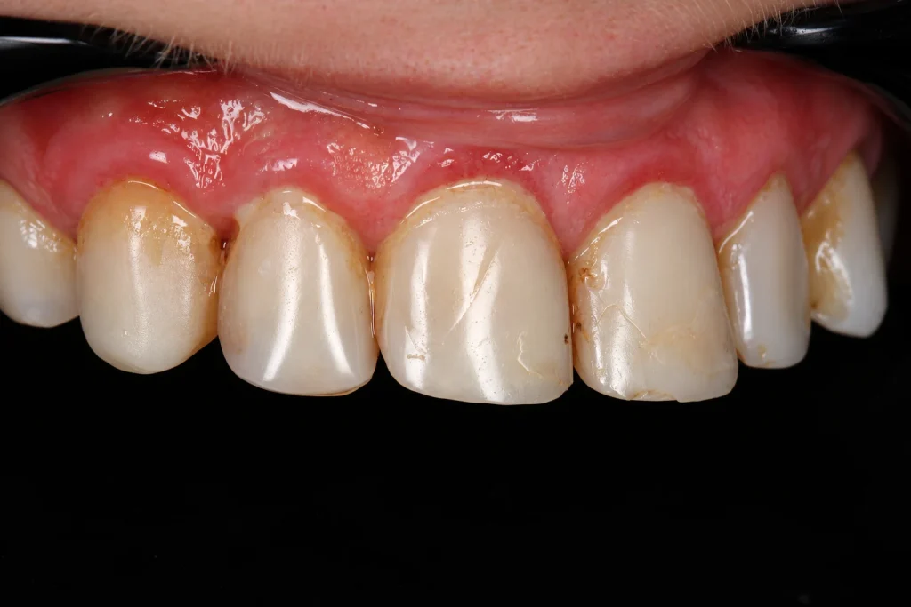 Шесть виниров с заменой старых реставраций - до